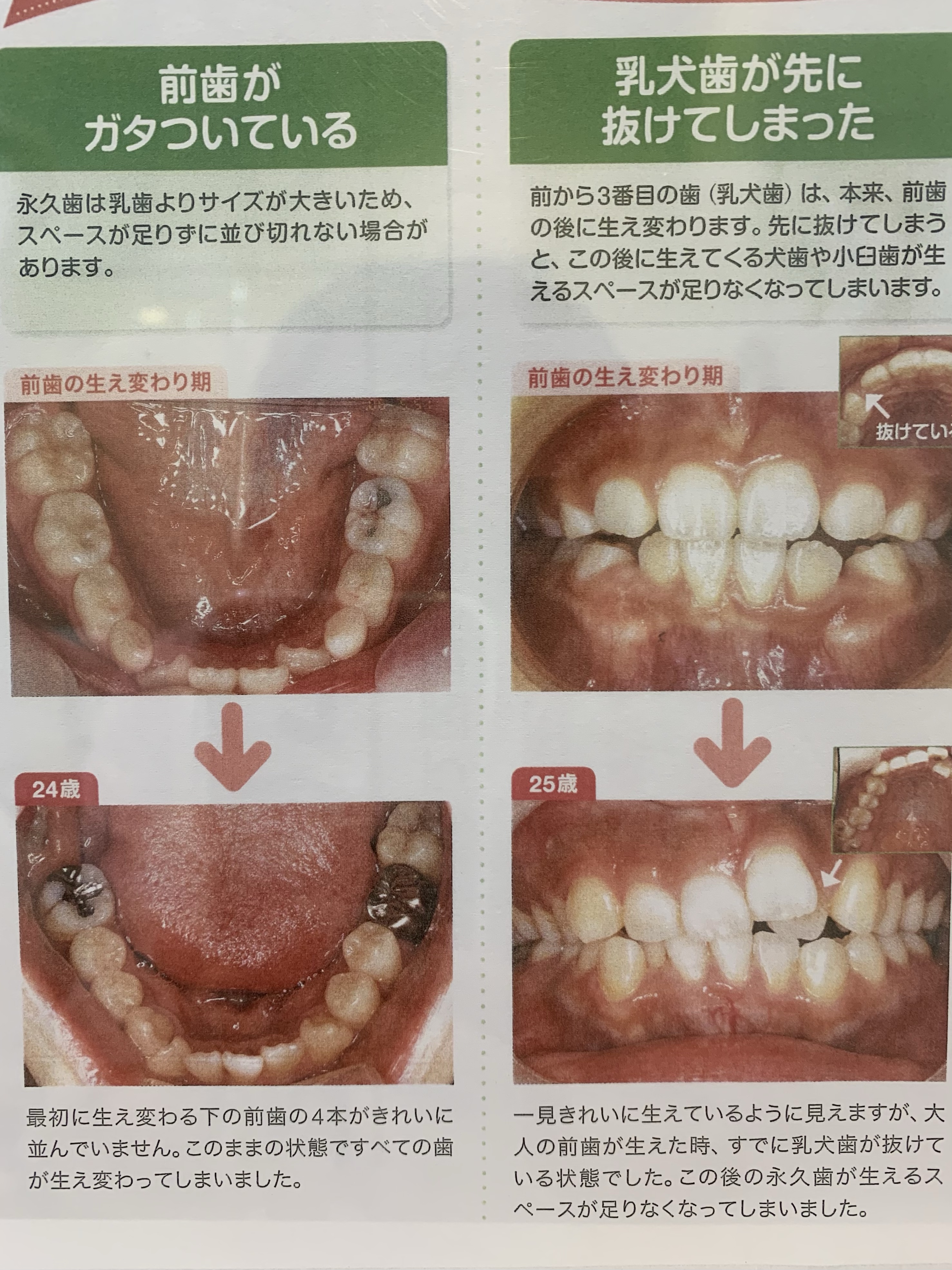 虫歯 麦茶 保育園での歯みがきについて質問です。全国で歯みがきの事故が多く、保育園での歯みがきがなく…